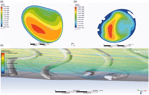 Figure 8. (a and b) Comparison of blood flow velocity of isolated and realistically stented coronary artery at point A. (c) Obstacle to the blood flow around the stent struts on the streamlines.