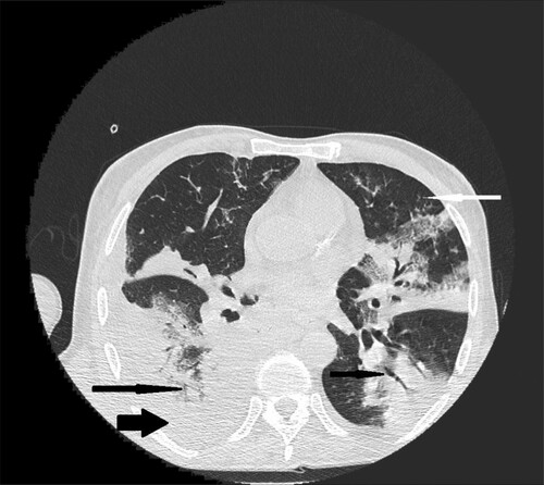 Figure 1. 66-year-old male with chronic lymphocytic leukemia, presenting with crepitations over the lung, cough and fever. High resolution CT scan obtained at level of pulmonary veins shows massive segmental consolidations with air bronchogram located in both lungs (black narrow arrows), nodules with halo sign (white narrow arrow) in lingular segment in left lung and free fluid in right pleural cavity (black wide arrow).