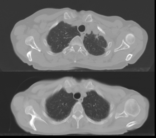 Figure 1.  Follow-up (upper) and pre-irradiation (lower) CT images for patient with dense (Grade 3) radiographic appearances.