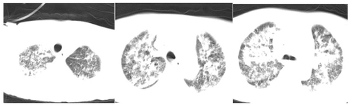 Figure 3 Diffuse infectious lesions in both lungs were seen in chest CT examination after transfer to ICU.