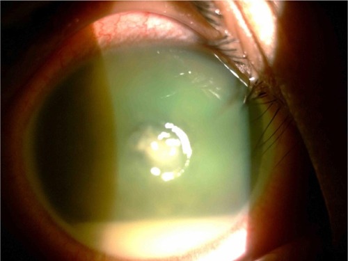 Figure 1 Right eye showing corneal ulcer centrally with hypopyon.