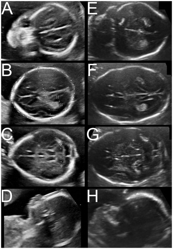 Figure 3. Images of the 20-week anomaly scan of a trigonocephaly and scaphocephaly patient. Images A–D show ultrasound images of a trigonocephaly patient. Images E–H show the ultrasound study of a scaphocephaly patient.