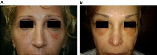 Figure 6 Dyschromia and visible material.