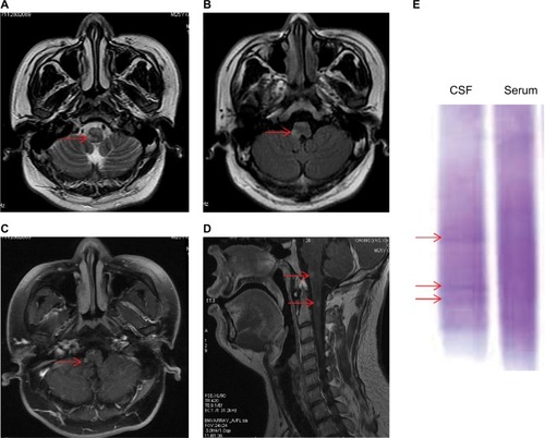 Figure 1 MRI findings and OB found in the CSF on admission.Notes: MRI of the brain revealed nodular regions of abnormal signal in the medulla oblongata and cervical cord, characterized by hyper-intensity on (A) T2-weighted and (B) flair sequences (arrow). (C and D) Nodular enhancing lesions were detected in the medulla oblongata and cervical cord (arrow). (E) OB found in the CSF (arrow).Abbreviations: CSF, cerebrospinal fluid; MRI, magnetic resonance imaging; OB, oligoclonal band.