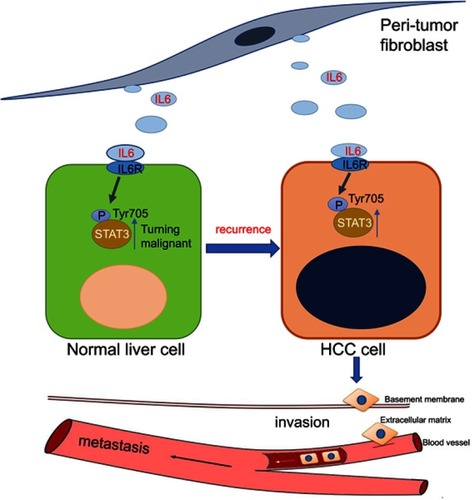 Figure 7 Hypothesis: after surgery, PTFs can stimulate surrounding hepatocytes to transform into a malignant phenotype, leading to hepatocarcinogenesis and tumor recurrence. Then PTFs significantly promote the progression and metastasis of HCC. IL-6/STAT3 signaling pathway plays a critical role in both stages.Abbreviations: HCC, hepatocellular carcinoma; PTFs, peri-tumor fibroblasts.