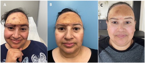 Figure 4. (A) Planning for tattoo-based restoration of the right eyebrow; (B) After two microblading sessions; (C) After hyperpigmentation has subsided (June 2023).