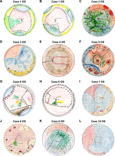 Figure 1 Fundus drawings.