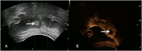 Figure 3. Ultrasound-guided HIFU treatment. Overall gray-scale change was seen during the surgery (A), while the vascular flow disappeared and the contrast-enhanced ultrasound showed no perfusion of uterine lesion immediately after the surgery (B). HIFU, high-intensity focused ultrasound.