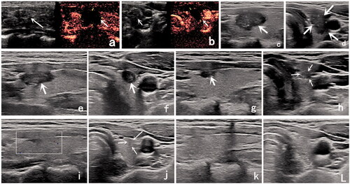 Figure 1. Ultrasound (US) image of a 33-year-old woman with a low-risk papillary thyroid microcarcinoma (PTMC). (a) Before radiofrequency ablation (RFA), US image showing a tumor (arrow) located in the right thyroid lobe; it had an initial volume of 307.13 mm3. (b) Immediately after RFA, the volume of the ablation area (arrow) was 852.82 mm3 on contrast-enhanced ultrasound. (c,d) One month after RFA, the volume of the ablation area (arrow) was 556.09 mm3. (e,f) Three months after RFA, the volume of the ablation area (arrow) was 164.12 mm3. (g,h) Six months after RFA, the volume of the ablation area (arrow) was 26.90 mm3. (i,j) Nine months after RFA, the ablation area could not be identified on the longitudinal US image. There was only a focal concavity in the capsule caused by shrinkage of the scar (arrow) on the transverse US image. (k,l) Twelve months after RFA, the ablation area completely disappeared.