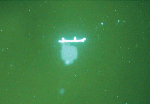 FIGURE 3  Potassium Hydoxide (KOH) staining of iris mass biopsy shows septate fungal filament with budding diagnostic of Aspergillus fumigatus (KOH x 200)