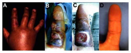 Figure 1 A 46-year-old man, 2 days after snakebite injury (A), 10 days after injury (B), 4 weeks after injury, the bitten skin had become necrotic (C). Five years after the skin graft, the grafted skin has a very good appearance; however, permanent sensory disturbance in the tip of the index finger exists (D).