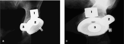 Figure 6. Radiographic depiction of the cup with metallic spacers in 20×20 mm defects. AP. a. Anteroposterior. b. 45° obturator oblique. c. Lateral view.