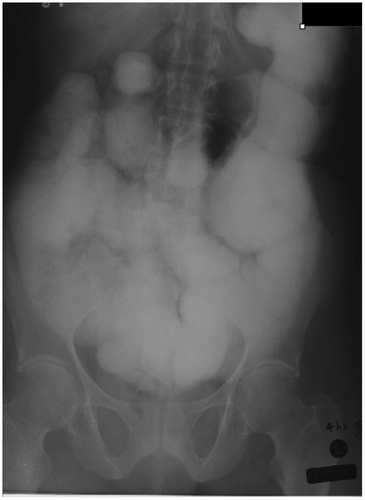 Figure 11: Small bowel follow-through study showing gross small bowel dilatation with dilution of barium and poor mucosal detail and poor delineation of the transition point due to overlapping bowel loops