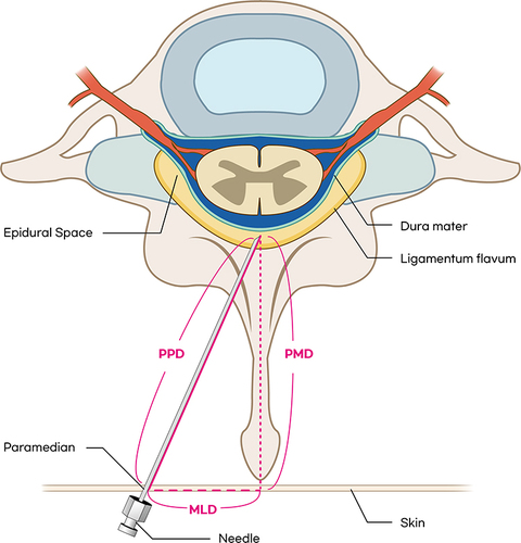 Figure 7 A schematic drawing of the cervical epidural block.