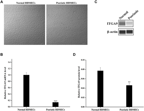 Figure 1 ITGA9 expression is downregulated in psoriatic HDMECs. (A) Cell morphology of primary psoriatic and normal HDMECs. Scale bar =100 μm. (B) Relative expression levels of ITGA9 mRNA analyzed by qRT-PCR. ***P < 0.001. (C and D) Expression levels of ITGA9 protein by Western blot. Expression levels were normalized to β-actin. **P < 0.01. N= 6 for all.