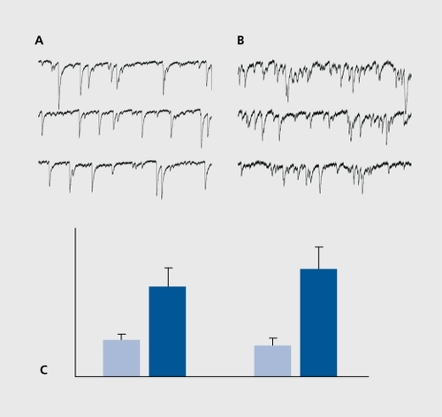 Figure 4. Enhanced glutamatergic activity in epileptic hippocampus weeks after the inaugurating event. Slices were prepared from rats 4 weeks after the status produced by a single injection of pilocarpine. Note the considerable increase of spontaneous glutamatergic activity in the epileptic hippocampus (right side) versus a control slice (left). A: control; B: epileptic; C: The bottom left column illustrates the increase quantitatively (in frequency of glutamate EPSCs). The right columns show a similar increase in the miniature PSCs recorded after applications of tetrodoxin (TTX) to block activity-dependent currents. This suggests a longlasting increase in quantal release of transmitter in the epileptic network.Citation53 EPSCs, excitatory postsynaptic currents; PSCs, postsynaptic currents