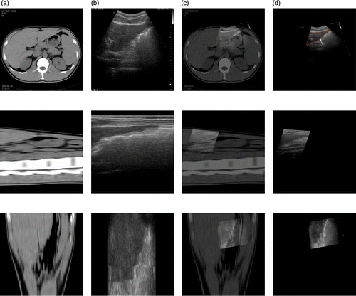 Figure 8. Registration between CT and ultrasound images of the liver. (a) Reference image in axial (top), sagittal (middle) and coronal (bottom) planes. (b) Floating image in axial, sagittal and coronal planes. (c) Fused image after affine registration in axial, sagittal and coronal planes. (d) Deformed floating image after local non-rigid registration in axial, sagittal and coronal planes.