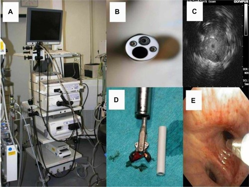 Figure 2 (A) Olympus tower, ready to use for bronchoscopy, mini-probe ultrasound, or endobronchial ultrasound. (B) Bronchoscope and (C) the “Stop effect” showing a tumor by mini-probe ultrasound. The Olympus ultrasound tip stops as it meets tumor tissue inside subsegmental alveolar tissue. (D) Biopsy forceps with tissue material and (E) Aspiration probe.