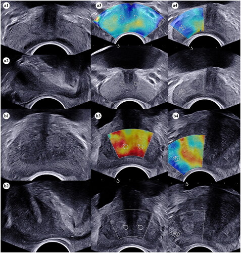 Figure 1. The process of volume and stiffness measurements of the prostate for the BPH and control group. (a1) The transverse diameter and anteroposterior diameter of the prostate and the TZ were measured respectively in the axial plane by grey-scale ultrasound in the control group; (a2) the cephalocaudal diameter of the prostate and the TZ were measured respectively in the sagittal plane by grey-scale ultrasound in the control group; (a3) Quantitative stiffness data of the TZ in the middle part of prostate near the urethra were measured twice in the axial plane by SWE in the control group; (a4) Quantitative stiffness data of the PZ in the right lobe of prostate were measured twice in the axial plane by SWE in the control group; (b1) The transverse diameter and anteroposterior diameter of the prostate and the TZ were measured respectively in the axial plane by grey-scale ultrasound in the BPH group; (b2) the cephalocaudal diameter of the prostate and the TZ were measured respectively in the sagittal plane by grey-scale ultrasound in the BPH group; (b3) Quantitative stiffness data of the TZ in the middle part of prostate near the urethra were measured twice in the axial plane by SWE in the BPH group; (b4) Quantitative stiffness data of the PZ in the right lobe of prostate were measured twice in the axial plane by SWE in the BPH group. Abbreviations: BPH, benign prostatic hyperplasia; TZ, transitional zone; PZ, peripheral zone; SWE, shear-wave elastography.