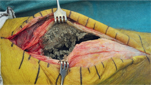 Figure 4. A 72-year-old man had a revision arthroplasty with hinge MoM after multiple failed knee arthroplasty revisions. After 3 years, he developed a massive soft tissue expansion around the distal femur. During revision arthroplasty, a thick-walled pseudotumor with solid components was encountered.