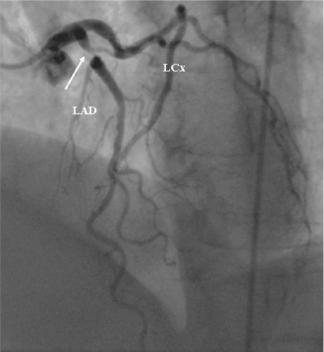 Figure 4 Coronary angiogram from the patient diabetes mellitus with developed unstable angina one week after that magnetic resonance imaging investigation suggested presence of significant coronary disease. Notice tight narrowing (arrow) in the proximal segment of left anterior descending artery (LAD).