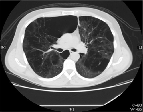 Figure 1 Panlobular emphysema with multiple bullas.