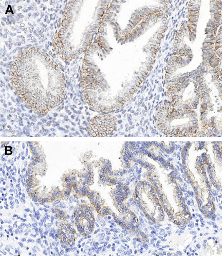 Figure S5 Immunohistochemical analysis expression of claudins 3 and 4 in endometrial polyps and endometrial cancer samples.