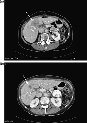 Figure 1.  A. Liver metastases (arrow) before embolization of the right liver lobe with SIR-Spheres™. B. Decrease in size of liver metastases 4 months after embolization of the right liver lobe with SIR-Spheres™. The indicated metastasis is clearly smaller and contains a central necrosis (arrow). The right liver lobe has begun to decrease, while a hypertrophy is seen of the left liver lobe.