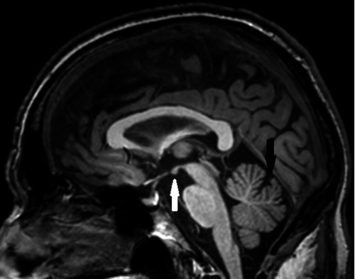 Figure 1 MRI sagittal image showing mild mammillary body atrophy (white arrow) and mild vermis atrophy (black arrow).