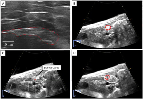 Figure 5. Histotripsy Treatment - Specialty Diet Chronic Pigs. US imaging of the pancreas before histotripsy indicated by dashed lines (A). US image with standoff prior to treatment and target identified by the dashed red circle (B). US image during treatment of bubble cloud generated in the pancreas (C) and after treatment with a clear hypoechoic region identifying the targeted ablated volume (D). Dashed red circle indicated the approximate region treated. Supplementary Video S2.