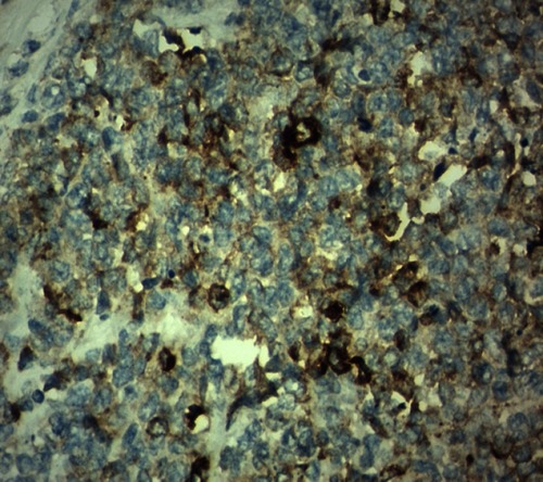 Figure 5 Synaptophysin cytoplasmic focal positive.