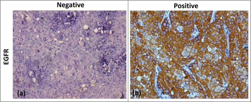 Figure 3. Microphotograph showing Immunohistochemical expression of EGFR in SCCHN (a) showing negative cytoplasmic and membranous staining (b) showing positive cytoplasmic and membranous staining (DAB × 125 × digital magnification).