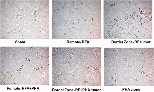 Figure 5. PHA reduces microvascular density levels following RFA. Microvascular density for RFA periablational rim vs RFA with PHA 7 days post treatment. Immunohistochemical staining for CD34 demonstrating increases in microvascular density post-RFA in local periablational rim and distant tumor. Addition of PHA to RFA reduced microvascular density levels to that similar to sham. ***Ablated zone adjacent to the periablational zone.