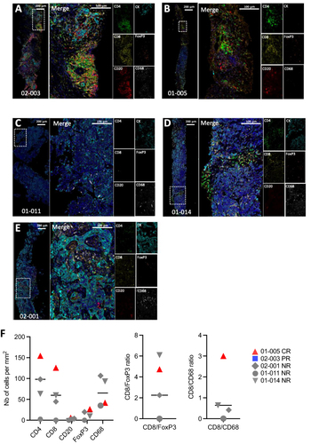 Figure 3 Baseline tumor immune contexture of patients with lymph node metastasis. (A–E). Representative illustrations of CD4 (green) - CD8 (yellow) - CD20 (red) - CD68 (white) - FOXP3 (Orange) - panCK (Cyan) - DAPI (Blue) multicolor IF staining of the invaded regions of metastatic lymph nodes from 5 patients before treatment. (F). Densities (nb of cells per mm2) of CD4+, CD8+ and FOXP3+ T cells, B cells (CD20+) and macrophages (CD68+) (left graph) and ratios of CD8+ T cells to FOXP3+ Tregs and of CD8+ T cells to CD68+ Macrophages. Patients who responded to treatment were highlighted as blue square for partial responder (PR) (02–003) and red triangle for complete responder (CR) (01–005).