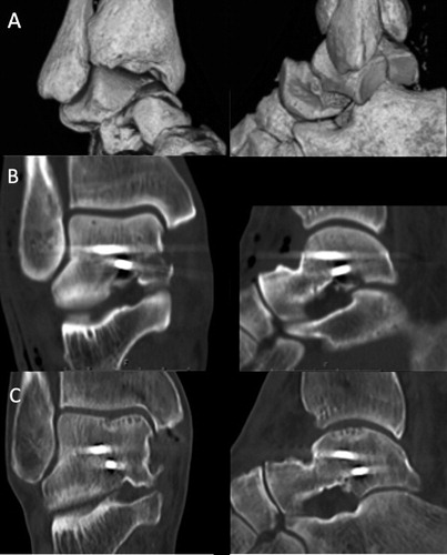 Figure 5. CT reconstruction demonstrating a Hawkins type 2b fracture with comminution of the talar dome (A) in a 60-year-old man after a low-energy fall. The fracture was reduced and fixed with 2 screws (B), followed by 6 weeks in a non-weight-bearing cast. No antiresorptive treatment was given. At 11.8 years postoperatively, the fracture was healed and the talar dome showed partial collapse (C). (SEFAS of 24).