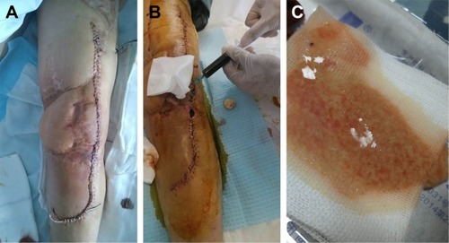 Figure 1 (A) The wound of the patient was in a good condition at the third postoperative day; (B) a sterile needle aspiration was performed, with removal of 40 mL of dark bloody fluid at the ninth postoperative day; (C) the yellowish fluid with tofu-like tissue was observed around sinus tract in the knee joint.
