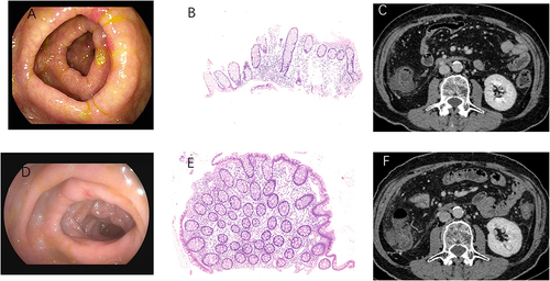 Figure 1 Colonoscopy revealed multiple hyperemia and edema of the transverse colon (A). Hematoxylin and eosin stained revealed chronic inflammation of colonic mucosa (B). No obvious abnormality was found on abdominal CT (C). The colonoscopy (D), hematoxylin and eosin stained (E) and abdominal CT (F) after sulfasalazine treatment.