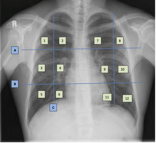 Figure 3 Frontal chest X-ray lung zone segmentation. The horizontal lines A and B represent the upper and lower poles of the hilum. The vertical line C is from the junction of the middle/inner third of the clavicle to the diaphragm. The light green squares are the regions in which radiologists assign a severity score.