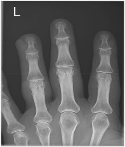 Figure 2. Radiographs of the left hand ring finger – PA view of the Left Index, Middle and Ring Fingers no obvious osseous pathology, left ring finger – increase density over the distal ulnar aspect of the left ring finger.