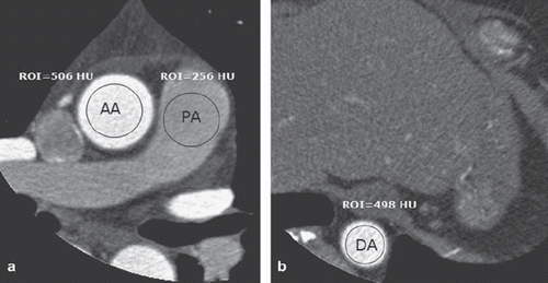 Fig. 2. Axial images of coronary CT angiography in the same patient as in Fig. 1 are shown. The attenuation numbers of the great arteries were 506 HU for the ascending aorta (AA), 256 HU for the main pulmonary artery (PA) (a), and 498 HU for the descending aorta (DA) at the level of the inferior margin of the heart as determined on axial images (b). The calculated consistency of contrast material was 8 HU.