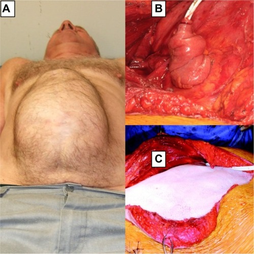 Figure 1 (A) Preoperative – incisional hernia visible; (B) ileal conduit; (C) biological mesh applied.