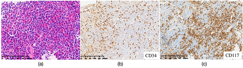 Figure 2 Morphology and immunohistochemistry of bone marrow biopsy. Biopsy showed a hypercellularity BM. The tumor cells shared similar histology morphology characteristics with the myeloid blast cells. And a large proportion of unexpected small round cells with sparse basophilic granules was discovered (a). Myeloblast showed positive for CD34 (b). Immunostaining revealed there were more than 30% of cells strongly positive for CD117 (c).