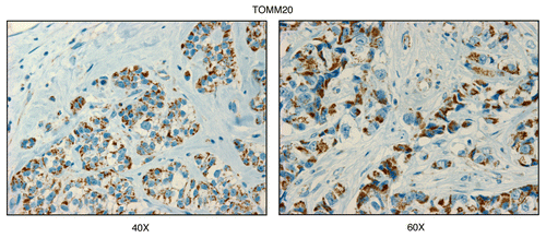 Figure 1 TOMM20, a mitochondrial marker protein, is preferentially expressed in human epithelial cancer cells, in breast cancer patients. Paraffin-embedded sections of human breast cancer samples lacking stromal Cav-1 were immuno-stained with antibodies directed against TOMM20 (brown color). Slides were then counter-stained with hematoxylin (blue color). Note that TOMM20 is highly expressed in the epithelial compartment of human breast cancers that lack stromal Cav-1. Two representative images are shown. Original magnification, 40x and 60x, as indicated.