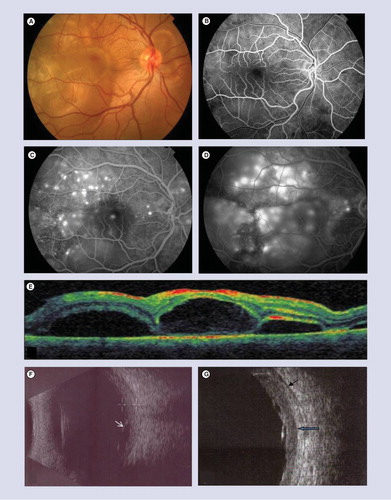 Figure 2. Acute Vogt–Koyanagi–Harada disease.(A) Fundus photography shows bilateral exudative retinal detachment involving the posterior pole with associated retinal and choroidal folds. (B) Early-phase fluorescein angiogram shows areas of delayed choriocapillaris filling. (C) Mid-phase fluorescein angiogram shows multiple pinpoints that enlarge with pooling of dye in subretinal space in the late-phase (D). (E) Optical coherence tomography shows exudative retinal detachment with subretinal septa dividing the subretinal space into several compartments. (F) 10-MHz ultrasonography of the same patient shows diffuse-low to medium-reflective choroidal thickening most marked in the posterior fundus and associated exudative retinal detachment (white arrow). (G) 20-MHz ultrasonography shows better definition of sclero-choroidal limit (blue arrow) and episcleral space (black arrow) with more accurate measurement of choroidal thickening.