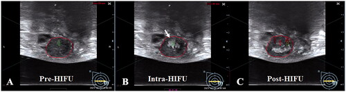 Figure 4. The significant gray scale changes during HIFU treatment for breast fibroadenomas. A. Pre-HIFU ultrasound showed a hypoechoic breast fibroadenoma (red ring). B. A significant gray scale changes was observed during HIFU (white arrow). C. The significant gray scale changed area covered the whole fibroadenoma.