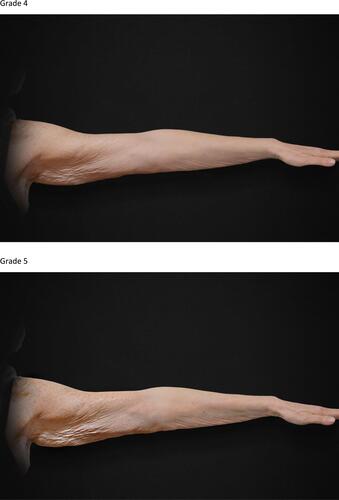 Figure 3 The 5-grade IBSA inner arm laxity scale. Grade 1. Grade 2. Grade 3. Grade 4. Grade 5.