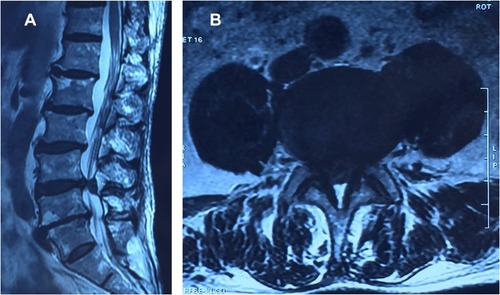 Figure 2 Sagittal (A) and axial (B) magnetic resonance imaging showing a large herniated disc at L4-L5 level.