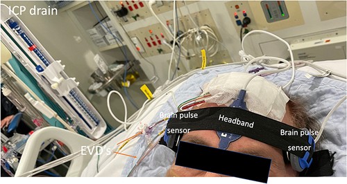 Figure 3 A brain pulse monitor was placed on each temple. A NellcorTM SPO2 A skin pulse oximeter was placed on the forehead (midline) to provide a reference conventional skin PPG waveform for comparison. The extra-ventricular drains (EVD) used to measure intracranial pressure are highlighted by the Orange arrows.