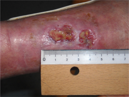 Figure 2 Lesions upon admission.