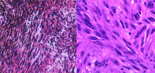 Figure 3 The pathological examination of a GIST presenting as a huge abdominal mass removed from a 28-year-old female.